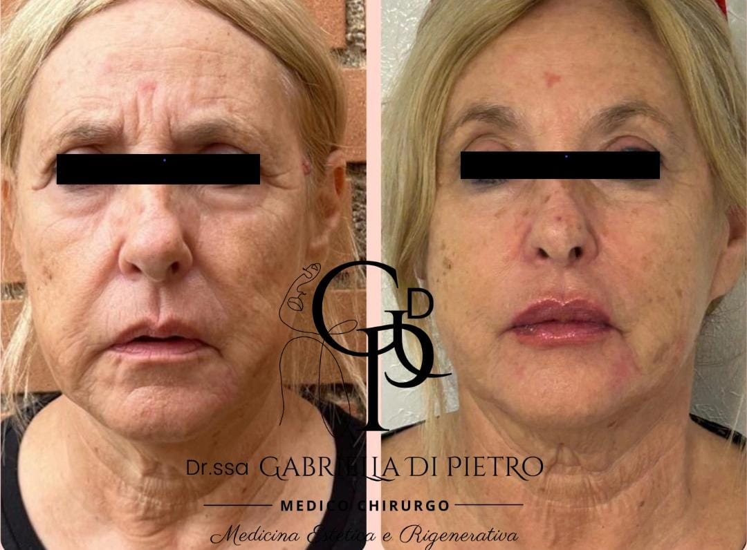 Biobotox