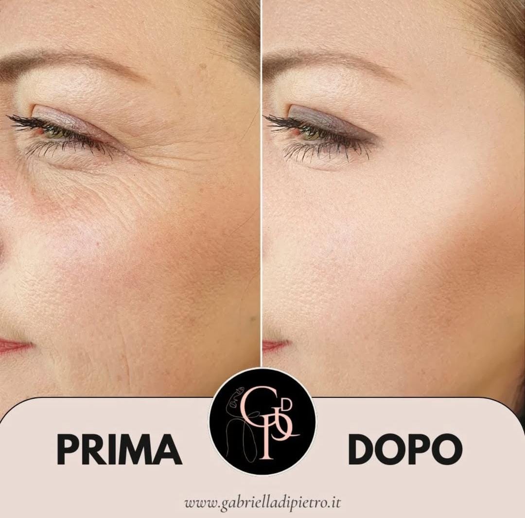 Botox