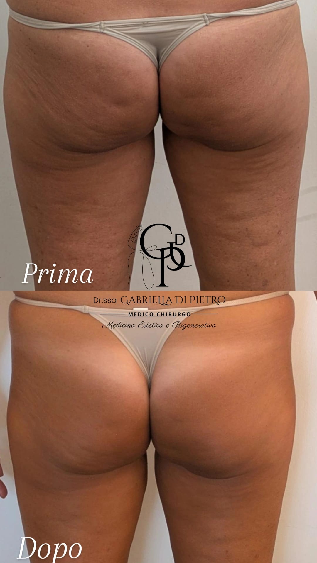 Carbossiterapia glutei
