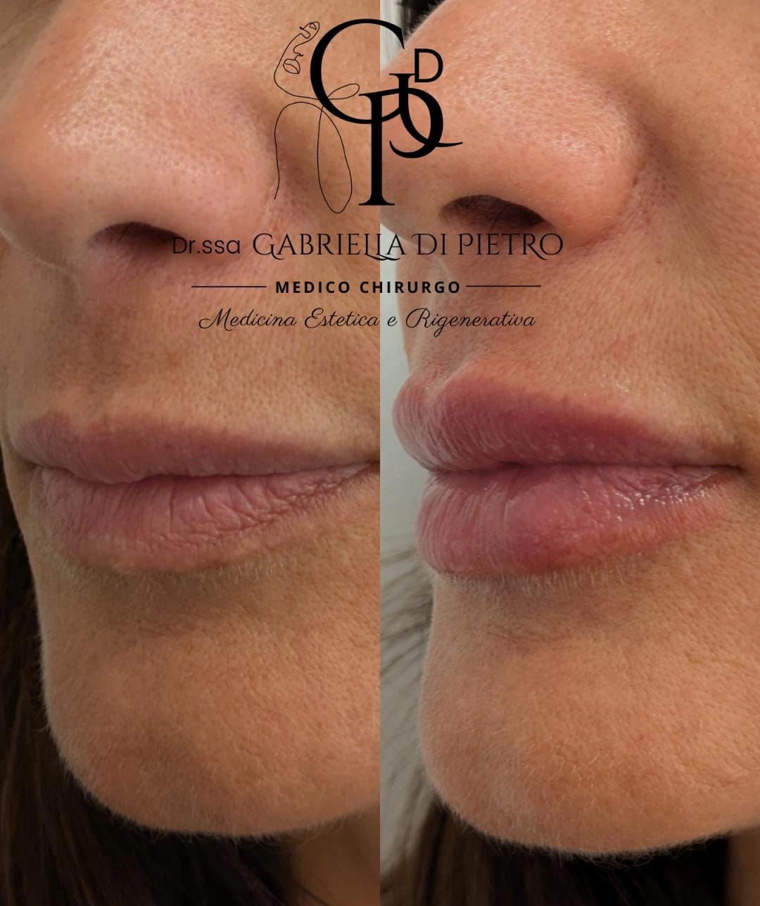 Filler labbra 1